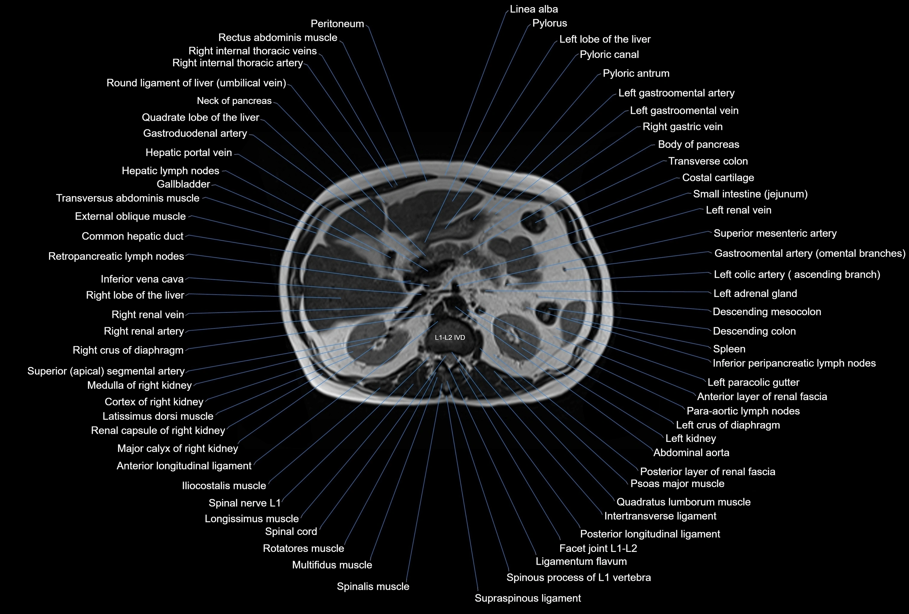 MRI Abdomen axial cross sectional anatomy radiology  image-img-00001-00018.webp